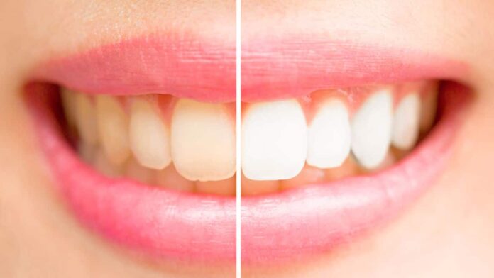 esses-alimentos-e-bebidas-podem-quebrar-o-esmalte-dos-dentes-e-contribuir-para-manchas-e-caries. esses-alimentos-e-bebidas-podem-quebrar-o-esmalte-dos-dentes-e-contribuir-para-manchas-e-caries.