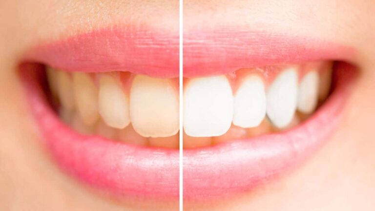 esses-alimentos-e-bebidas-podem-quebrar-o-esmalte-dos-dentes-e-contribuir-para-manchas-e-caries.